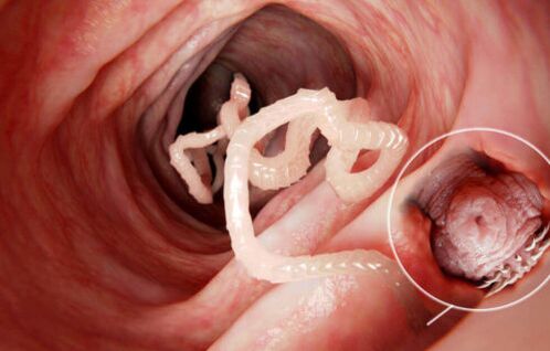 Worms are parasites in the human body