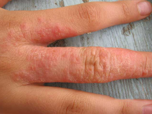 Rashes when worms