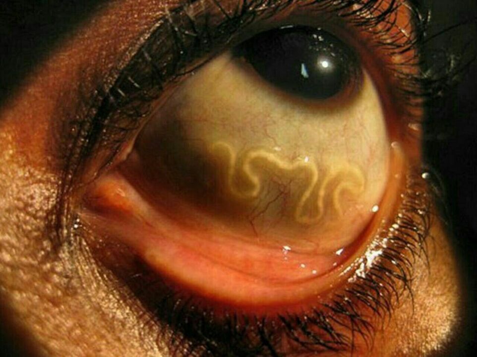 parasites in human eyes