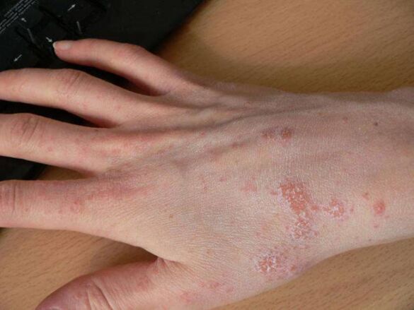 Scabies on hands, subcutaneous ticks